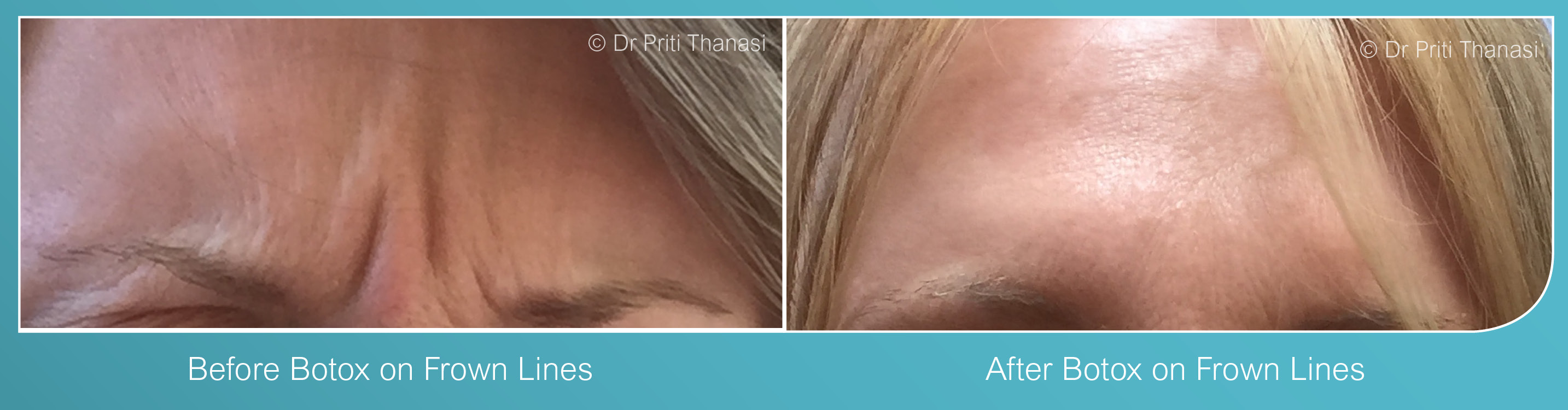 Botox in Syston, Leicester
